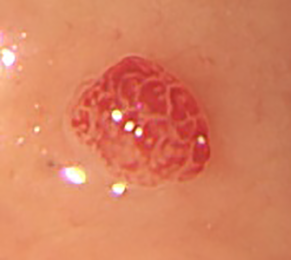 ラズベリー型胃腫瘍.1